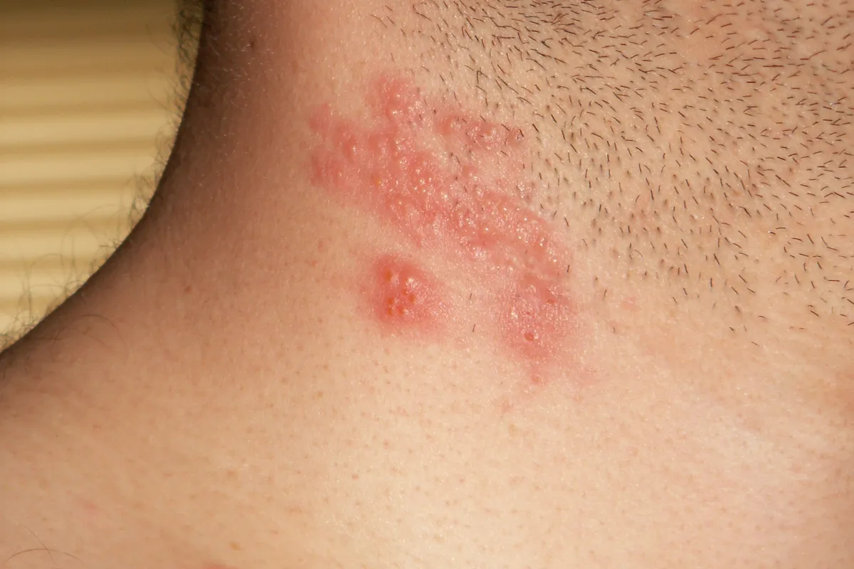Imate herpes zoster? Izbjegavajte ove 3 stvari